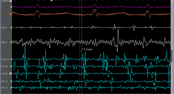 COMPARISON BEFORE: Intercardiac tracings before filter.